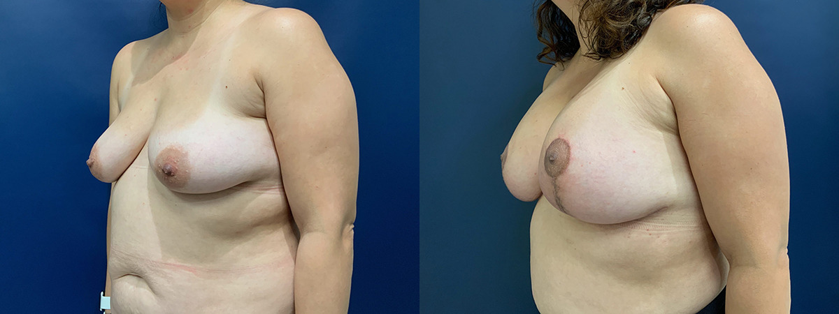 Breast Lift with Augmentation Before and After Photo by Dr. Patterson in Pensacola Florida