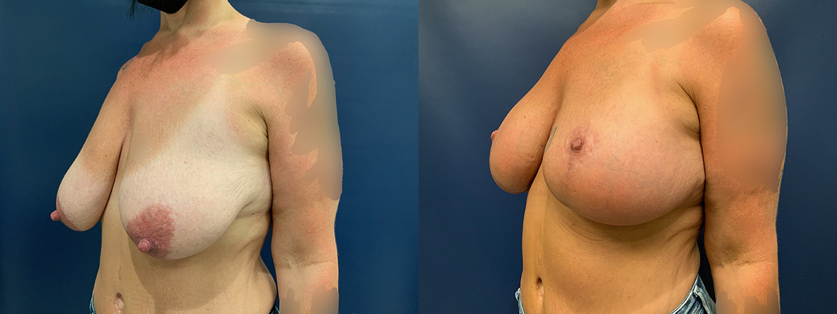 BREAST LIFT WITH AUGMENTATION Before and After Photo by Dr. Patterson in Pensacola Florida