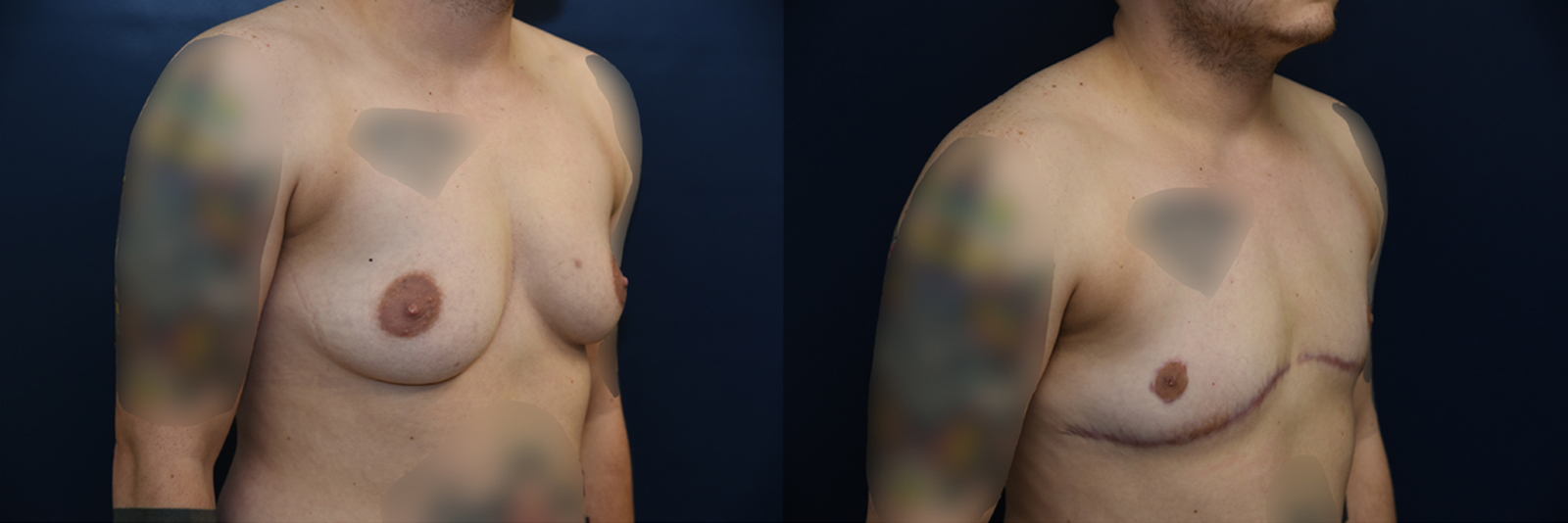 Female to Male Top Surgery Before and After Photo by Dr. Leveque of Gulf Coast Plastic Surgery in Pensacola, FL