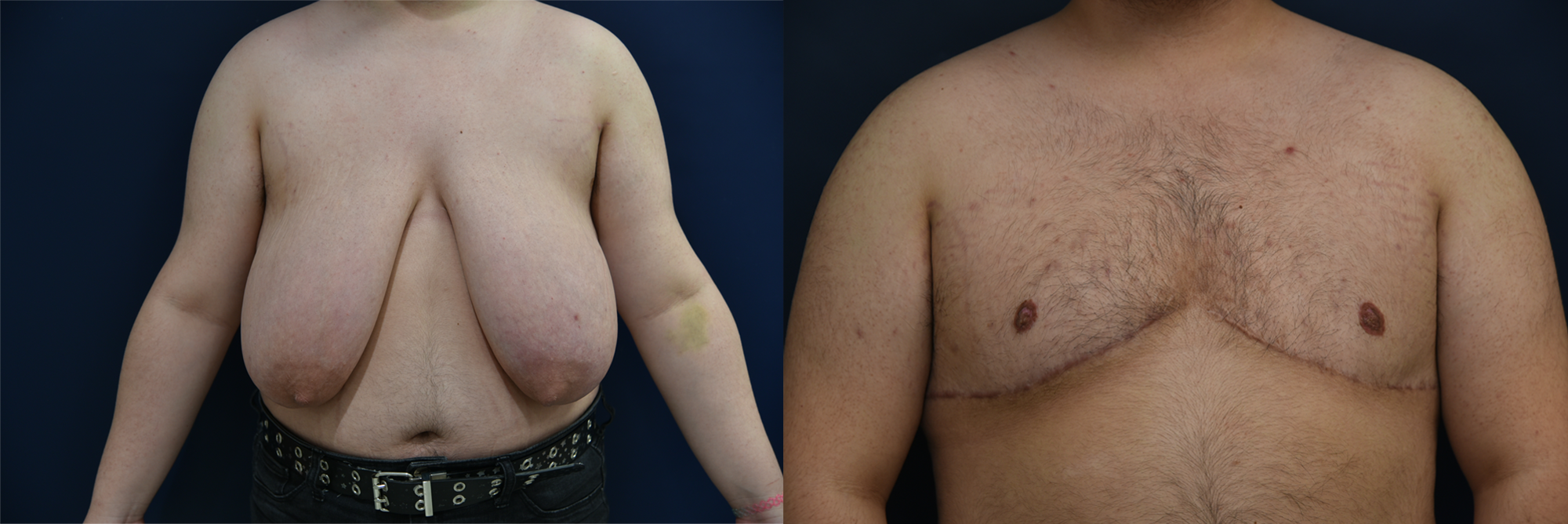 Female to Male Top Surgery Before and After Photo by Dr. Leveque of Gulf Coast Plastic Surgery in Pensacola, FL