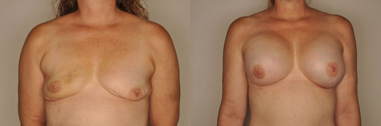 Breast Reconstruction Before and After Photo by Dr. Patterson in Pensacola Florida