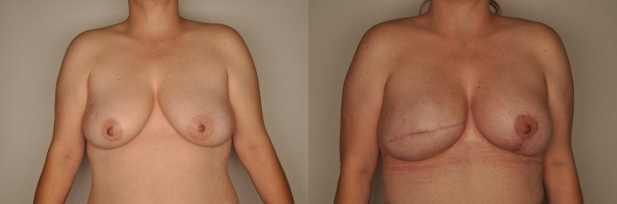 Breast Reconstruction Before and After Photo by Dr. Patterson in Pensacola Florida