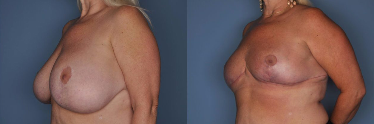 Breast Reduction Before and After Photo by Dr. Patterson in Pensacola Florida
