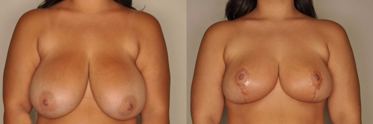 Breast Reduction Before and After Photo by Dr. Patterson in Pensacola Florida