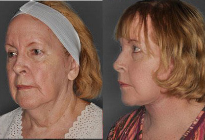 Face and Neck Lift Before and After Photo by Dr. Patterson in Pensacola Florida