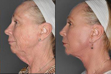 Face and Neck Lift Before and After Photo by Dr. Patterson in Pensacola Florida