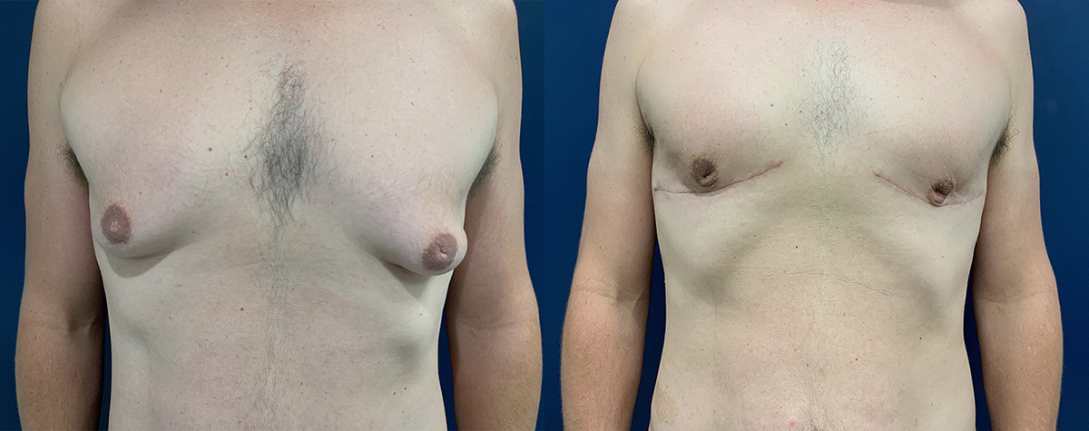 Gynecomastia Before and After Photo by Dr. Patterson in Pensacola Florida