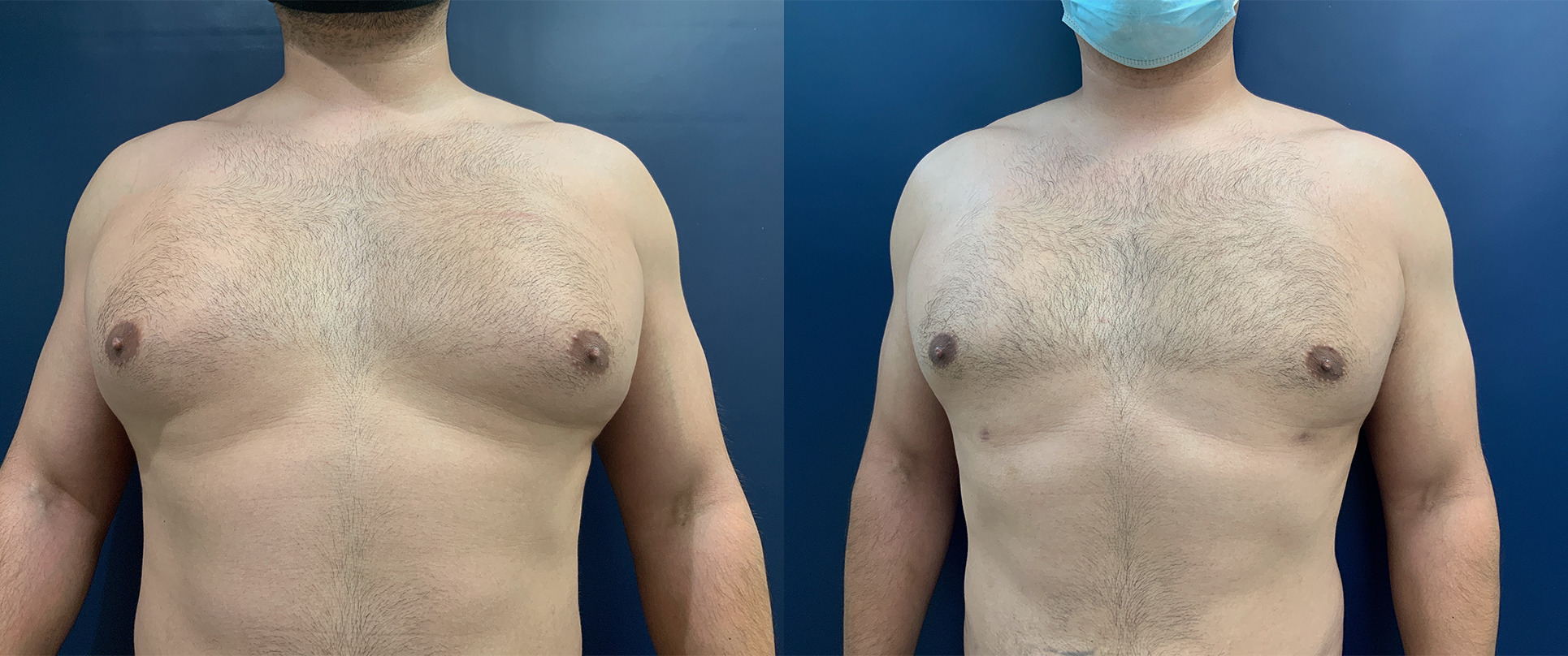 Gynecomastia Before and After Photo by Dr. Patterson in Pensacola Florida