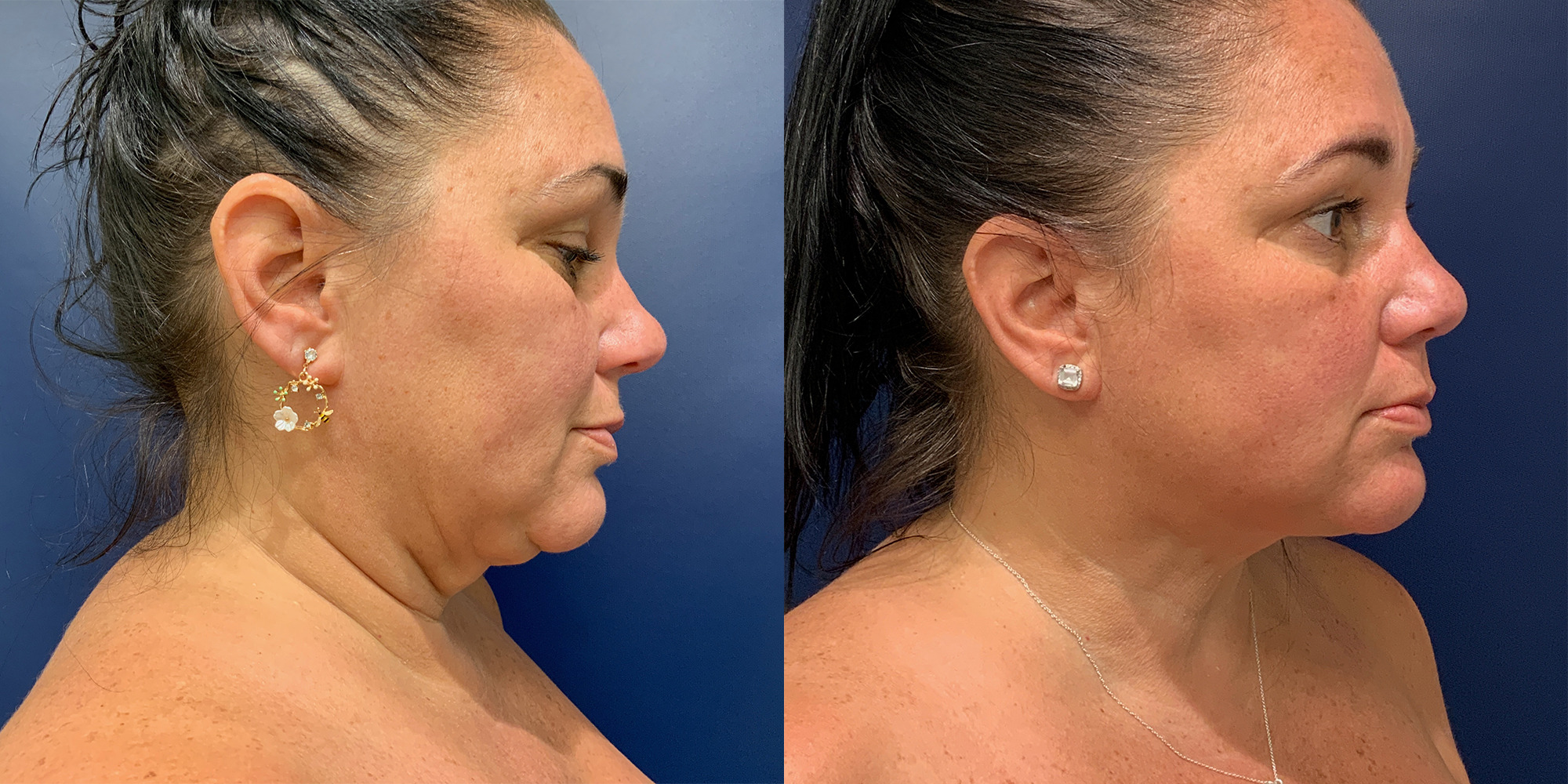 Liposuction of Neck Before and After Photo by Dr. Patterson in Pensacola Florida