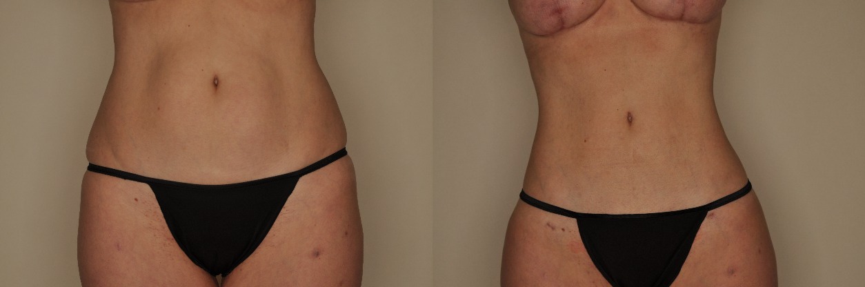 Liposuction Before and After Photo by Dr. Patterson in Pensacola Florida