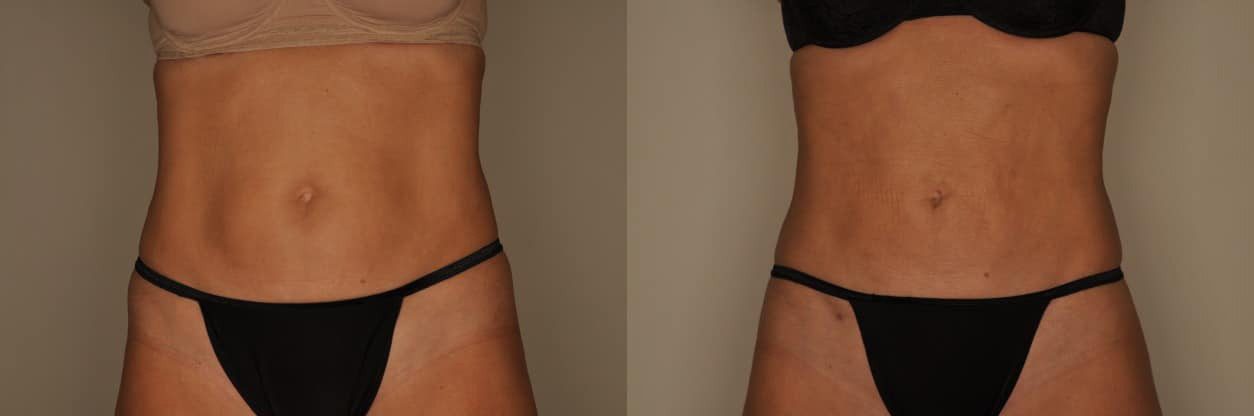 Liposuction Before and After Photo by Dr. Patterson in Pensacola Florida