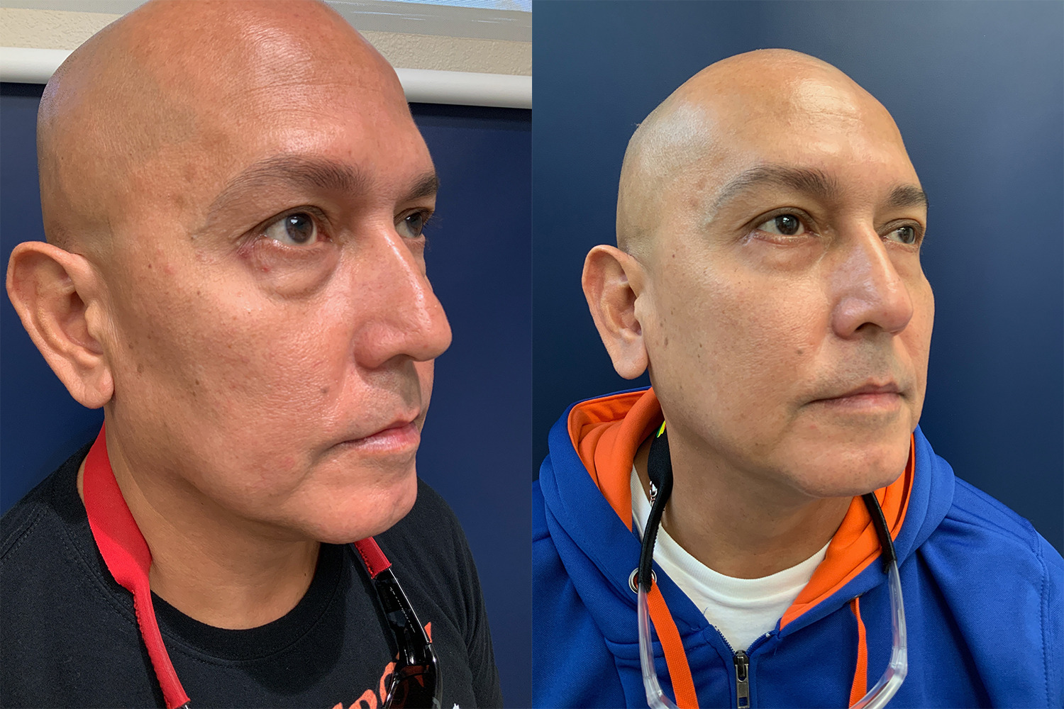 Lower Eyelid Lift Before and After Photo by Dr. Patterson in Pensacola Florida