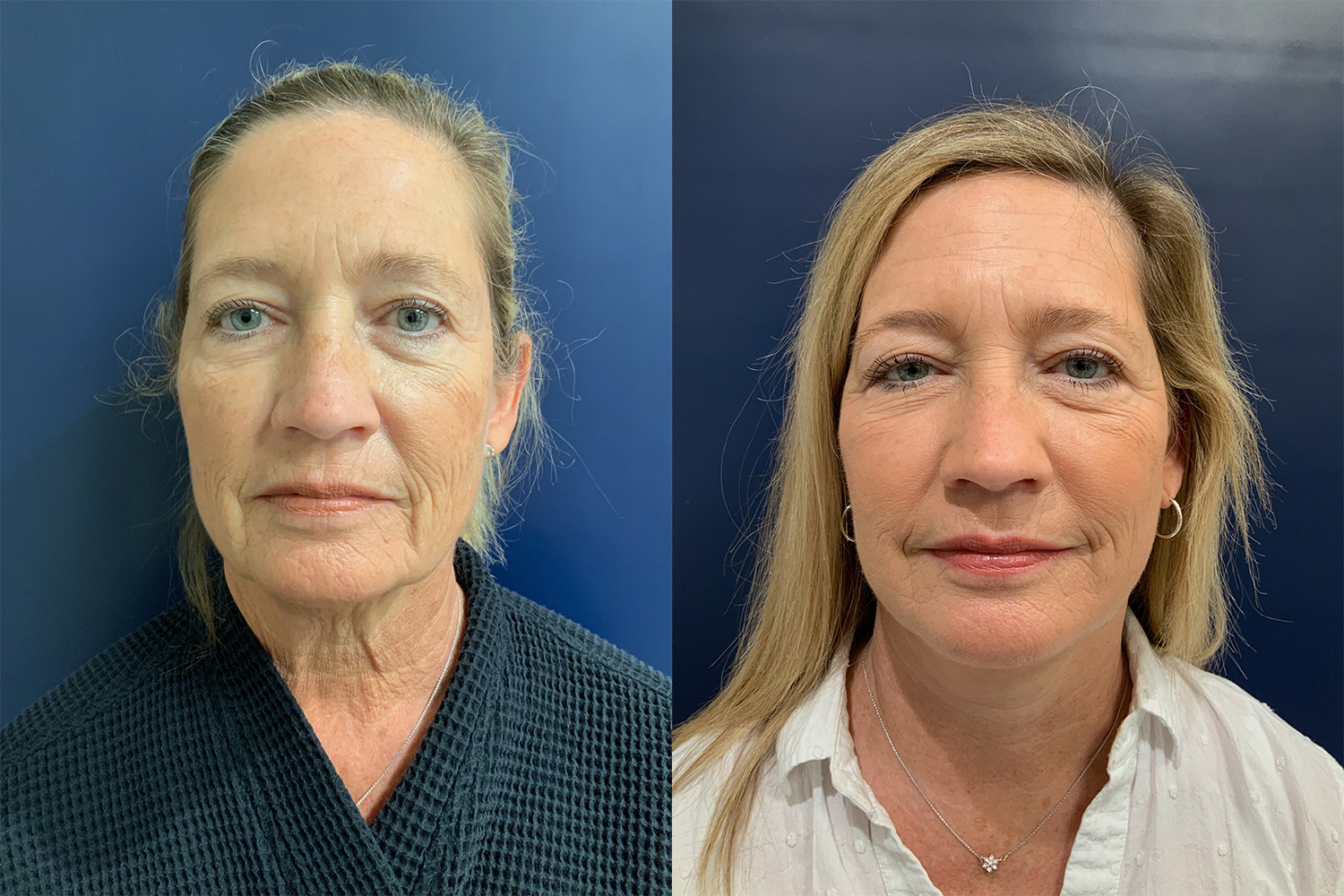 Mini Facelift Before and After Photo by Dr. Patterson in Pensacola Florida