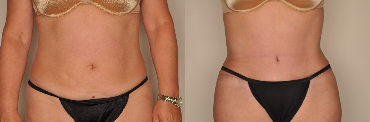 Tummy Tuck Before and After Photo by Dr. Patterson in Pensacola Florida