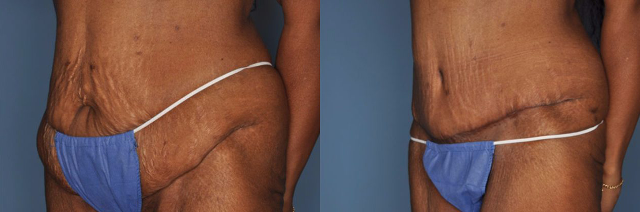 Tummy Tuck Before and After Photo by Dr. Patterson in Pensacola Florida