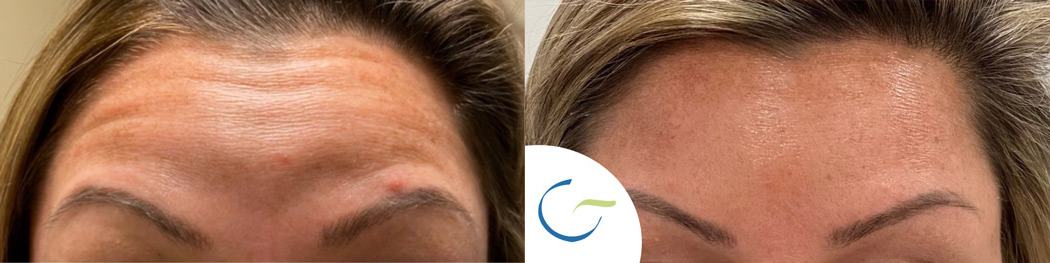 Botox Before and After Photo by APRN in Pensacola Florida