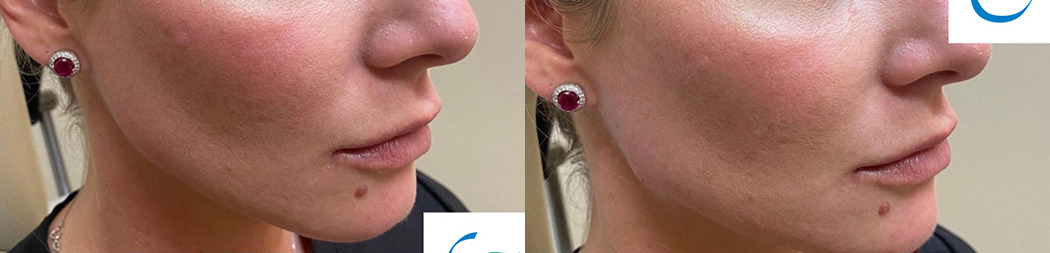 Fillers Before and After Photo by APRN in Pensacola Florida