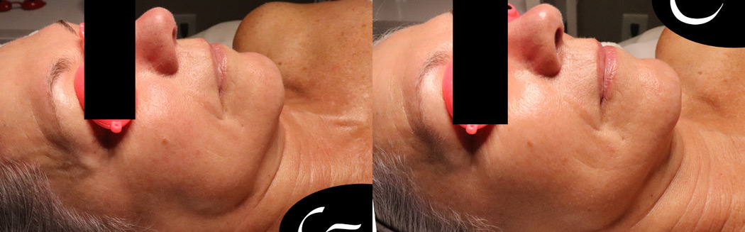 HydraFacial Before and After Photo by APRN in Pensacola Florida
