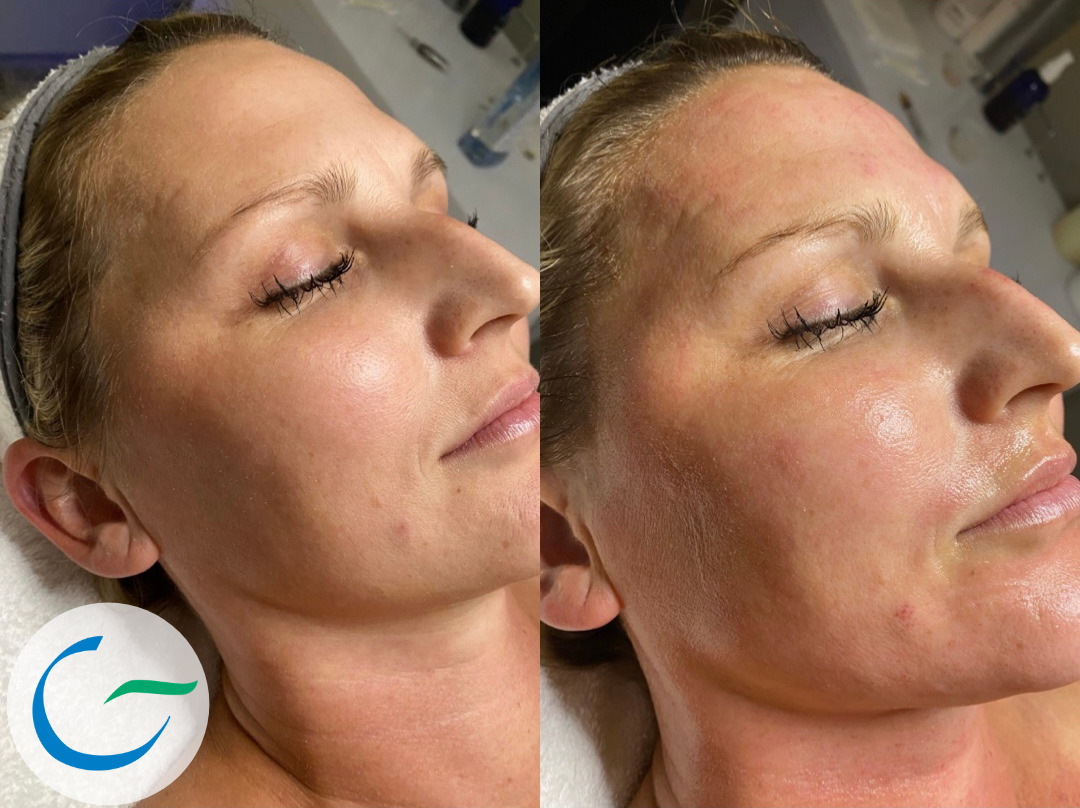 Microneedling Before and After Photo by APRN in Pensacola Florida