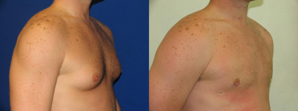 Gynecomastia Before and After Photo by Dr. Leveque of Gulf Coast Plastic Surgery in Pensacola, FL
