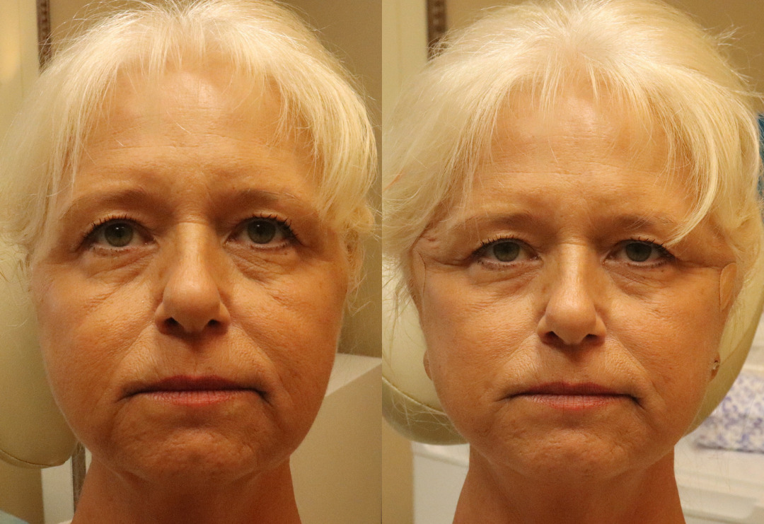 PDO Thread Lift Before and After Photo by APRN in Pensacola Florida