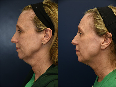Ulthera Before and After Photo by APRN in Pensacola Florida