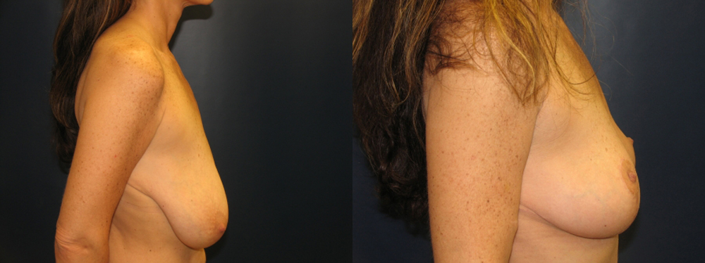Breast Lift Before and After Photo by Dr. Leveque of Gulf Coast Plastic Surgery in Pensacola, FL