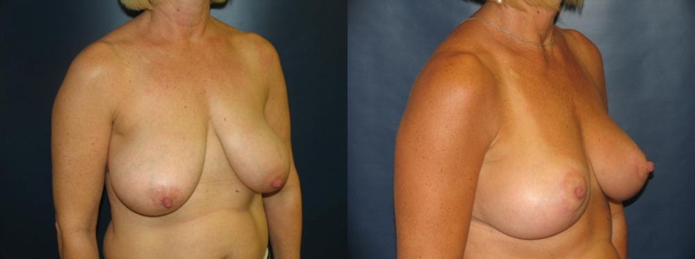 Breast Lift Before and After Photo by Dr. Leveque of Gulf Coast Plastic Surgery in Pensacola, FL