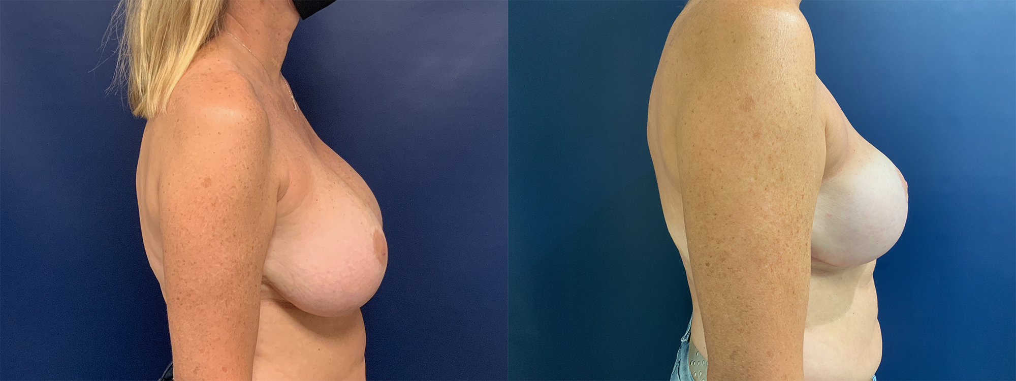 Breast Implant Removal Before and After Photo by Dr. Leveque of Gulf Coast Plastic Surgery in Pensacola, FL