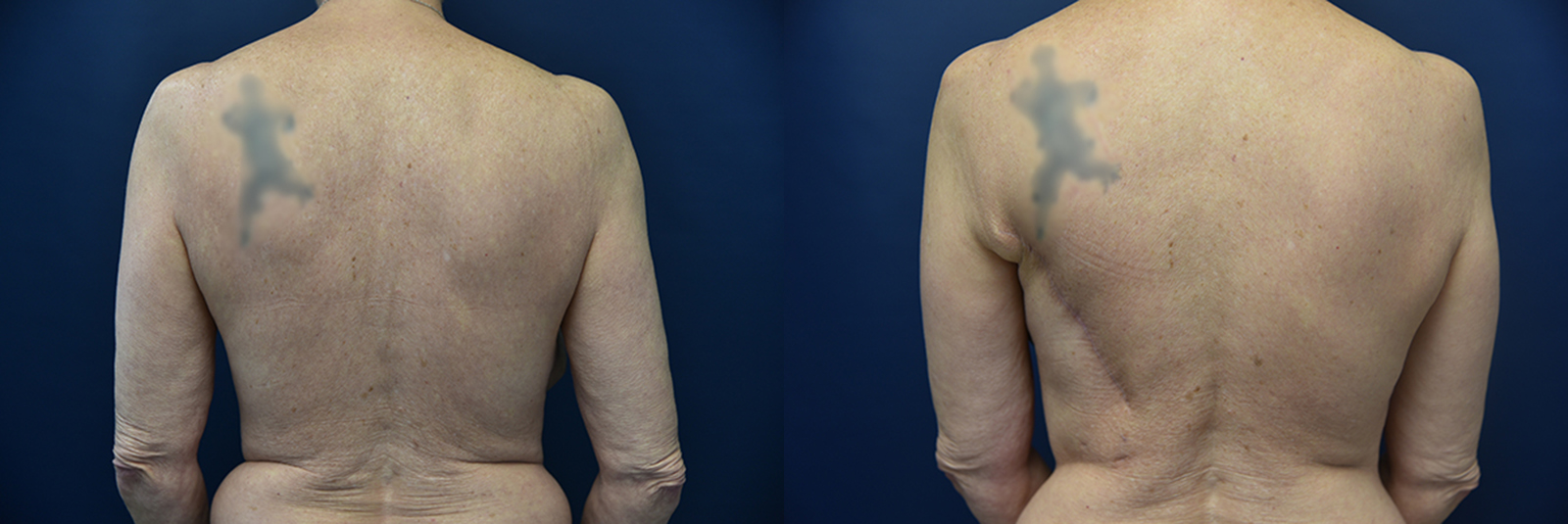 Latissimus Dorsi Before and After Photo by Dr. Leveque of Gulf Coast Plastic Surgery in Pensacola, FL