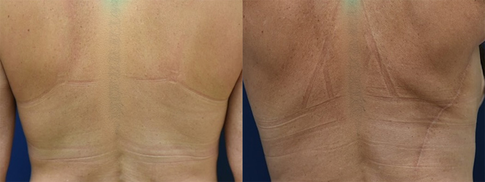 Latissimus Dorsi Before and After Photo by Dr. Leveque of Gulf Coast Plastic Surgery in Pensacola, FL