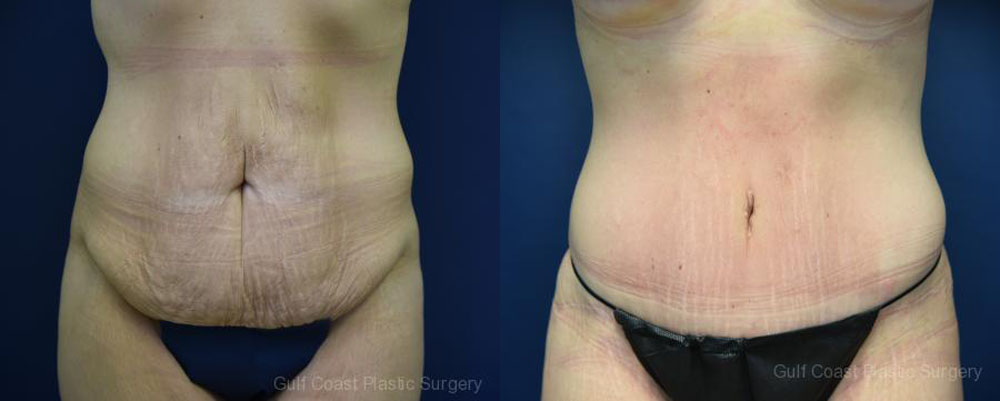 Tummy Tuck Before and After Photo by Dr. Leveque of Gulf Coast Plastic Surgery in Pensacola, FL