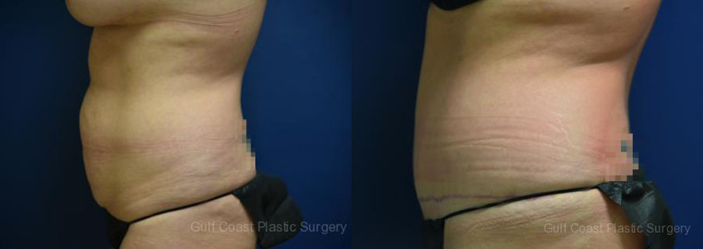 Tummy Tuck Before and After Photo by Dr. Leveque of Gulf Coast Plastic Surgery in Pensacola, FL