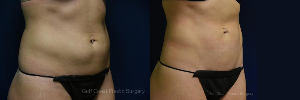 Liposuction Before and After Photo by Dr. Leveque of Gulf Coast Plastic Surgery in Pensacola, FL