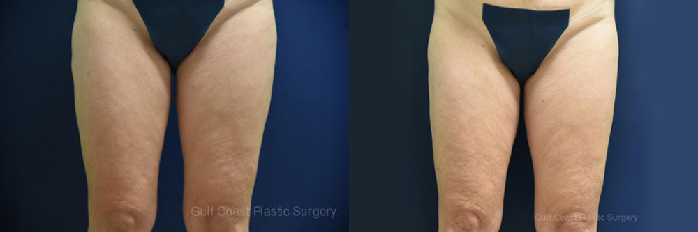 Liposuction Before and After Photo by Dr. Leveque of Gulf Coast Plastic Surgery in Pensacola, FL