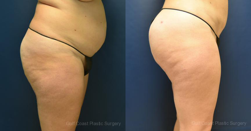Brazilian Butt Lift Before and After Photo by Dr. Leveque of Gulf Coast Plastic Surgery in Pensacola, FL