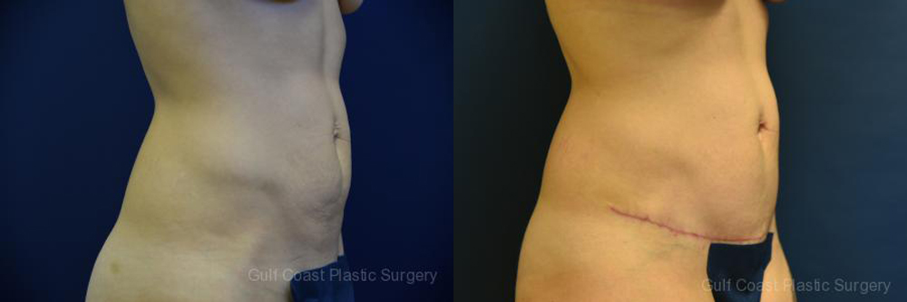 Mommy Makeover Before and After Photo by Dr. Leveque of Gulf Coast Plastic Surgery in Pensacola, FL