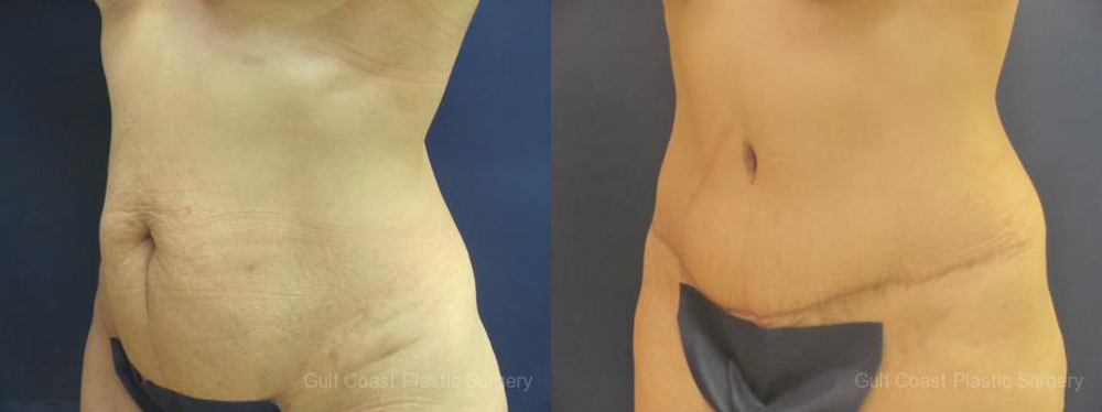Mommy Makeover Before and After Photo by Dr. Leveque of Gulf Coast Plastic Surgery in Pensacola, FL