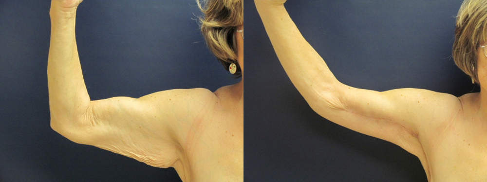 Brachioplasty Before and After Photo by Dr. Leveque of Gulf Coast Plastic Surgery in Pensacola, FL