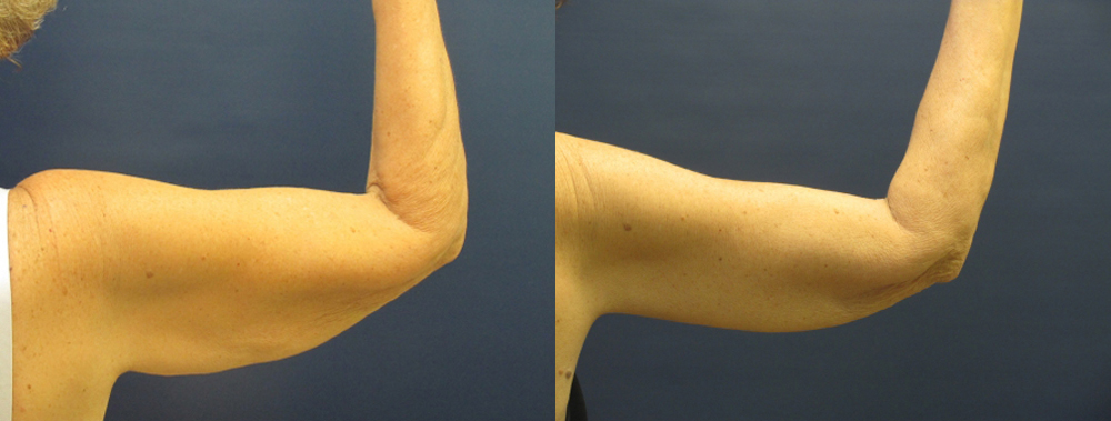 Brachioplasty Before and After Photo by Dr. Leveque of Gulf Coast Plastic Surgery in Pensacola, FL