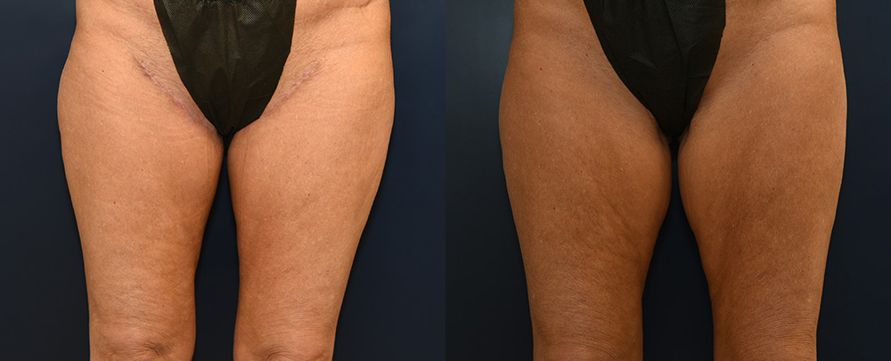 Thigh Lift Before and After Photo by Dr. Leveque of Gulf Coast Plastic Surgery in Pensacola, FL