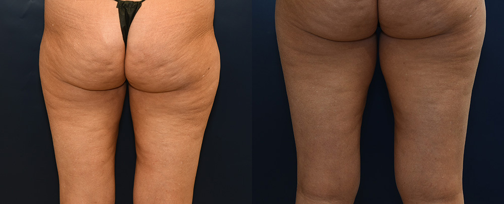 Thigh Lift Before and After Photo by Dr. Leveque of Gulf Coast Plastic Surgery in Pensacola, FL