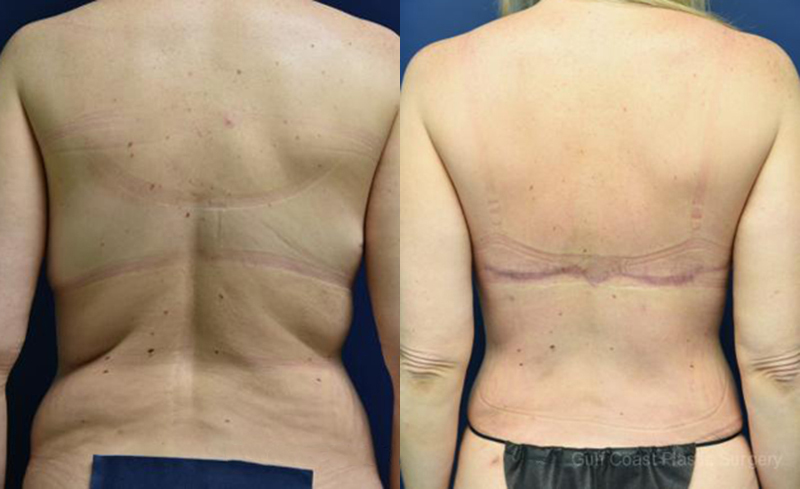 Back Lift Before and After Photo by Dr. Leveque of Gulf Coast Plastic Surgery in Pensacola, FL