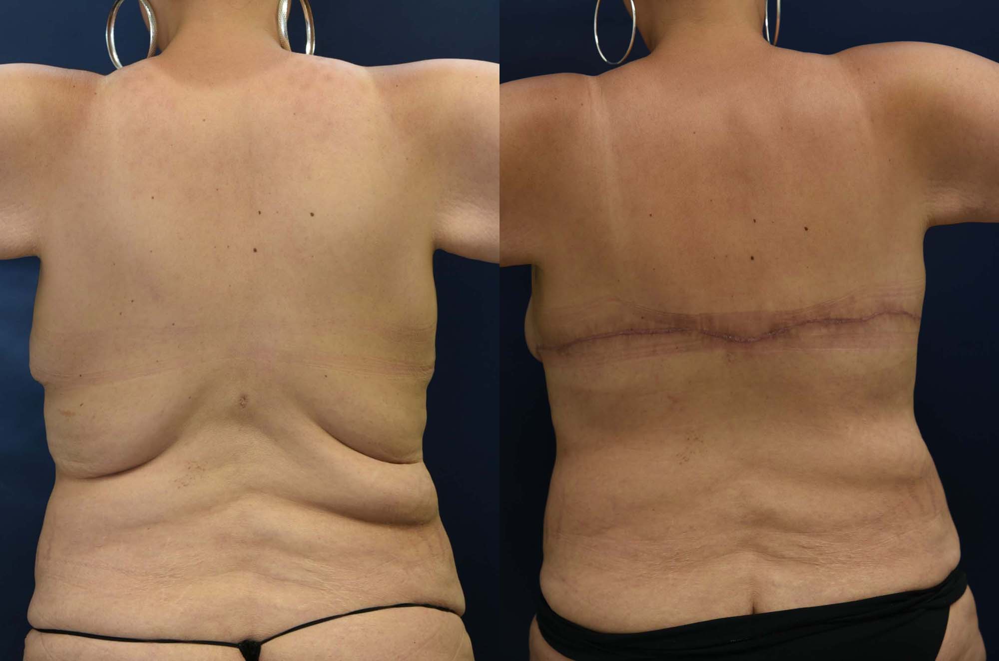 Back Lift Before and After Photo by Dr. Leveque of Gulf Coast Plastic Surgery in Pensacola, FL