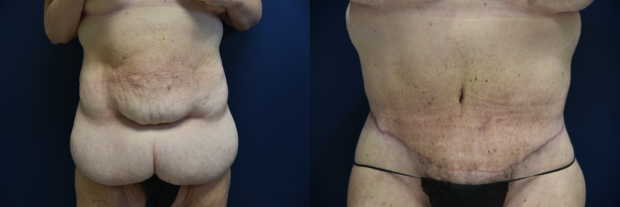 Body Lift after Major Weight Loss Before and After Photo by Dr. Leveque of Gulf Coast Plastic Surgery in Pensacola, FL