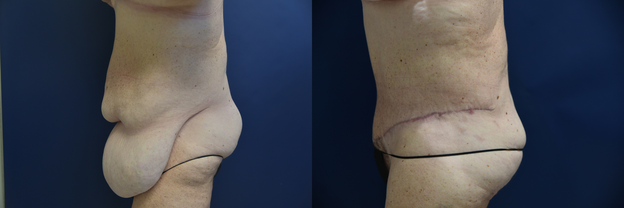Body Lift after Major Weight Loss Before and After Photo by Dr. Leveque of Gulf Coast Plastic Surgery in Pensacola, FL