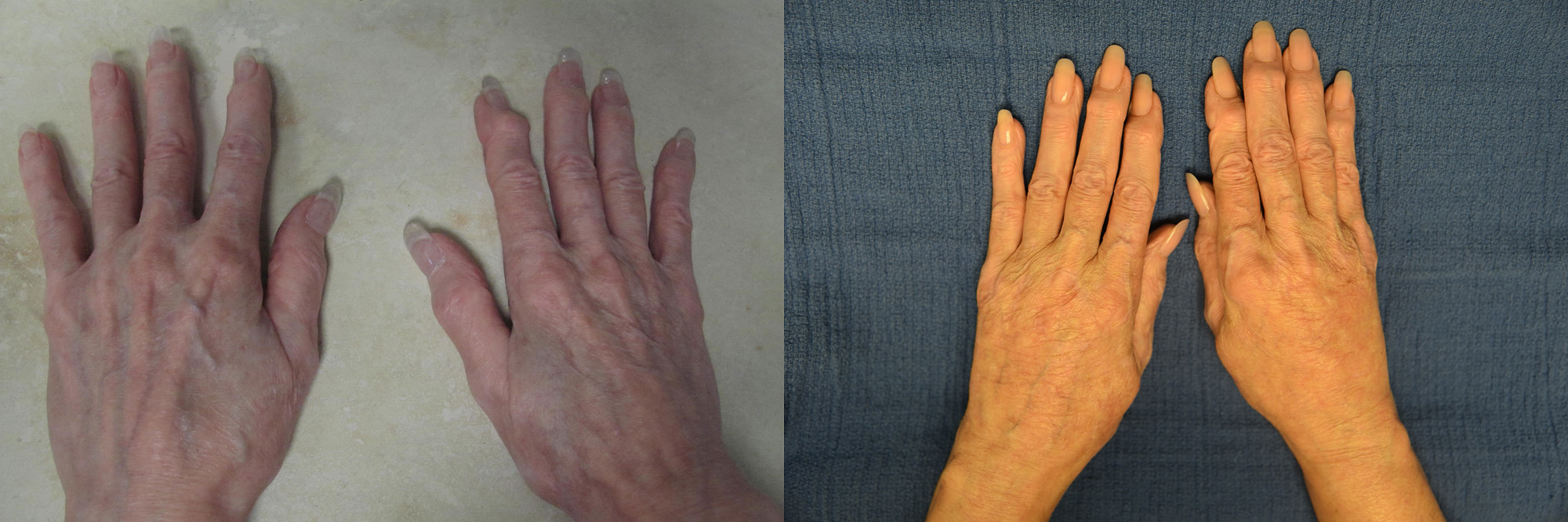 Fat Transfer Before and After Photo by Dr. Leveque of Gulf Coast Plastic Surgery in Pensacola, FL