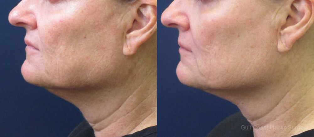 Ulthera Before and After Photo by Dr. Leveque of Gulf Coast Plastic Surgery in Pensacola, FL