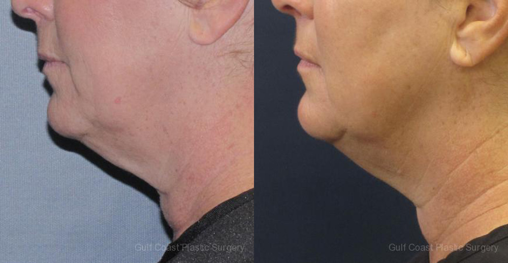 Ulthera Before and After Photo by Dr. Leveque of Gulf Coast Plastic Surgery in Pensacola, FL