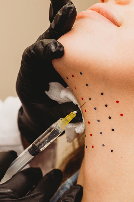 Kybella injections under the chin